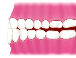 反対咬合（受け口）