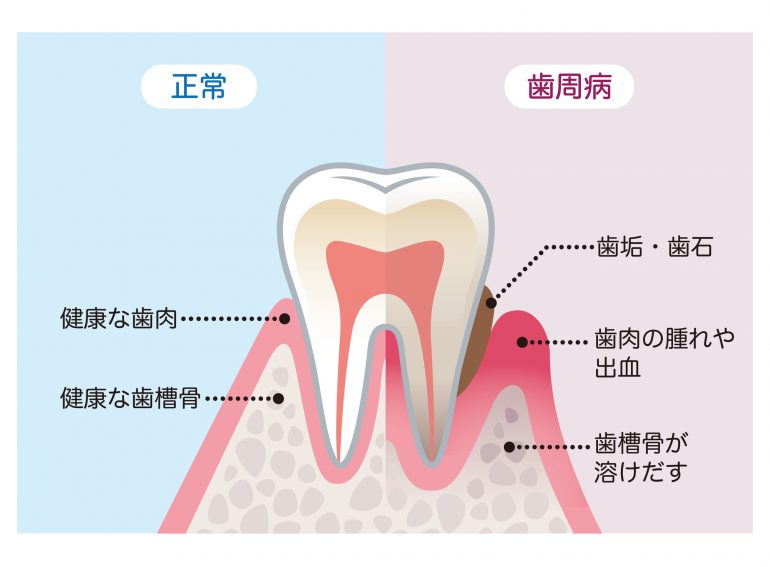 歯周病の主な原因