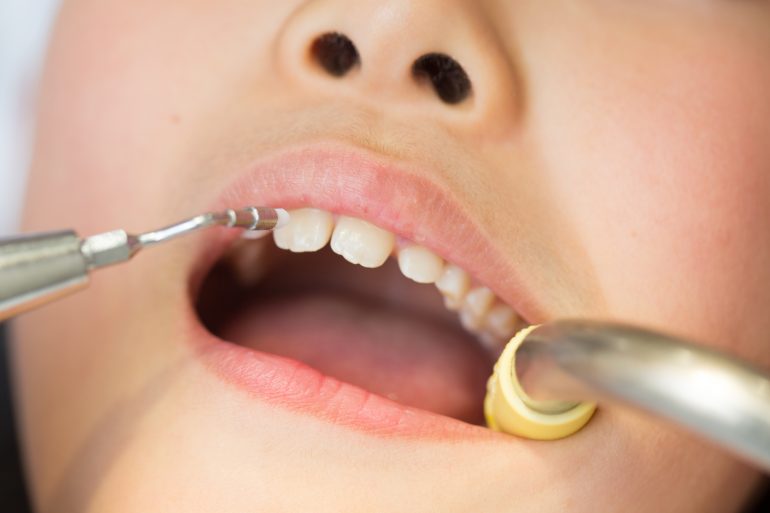 歯石の除去について