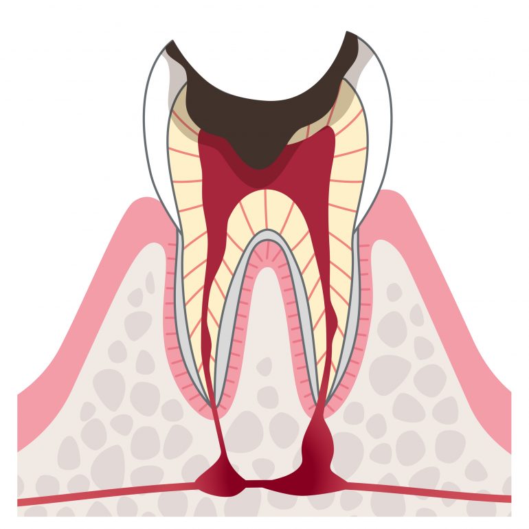 ステージ４　重度むし歯（歯髄炎・根尖性歯周炎）