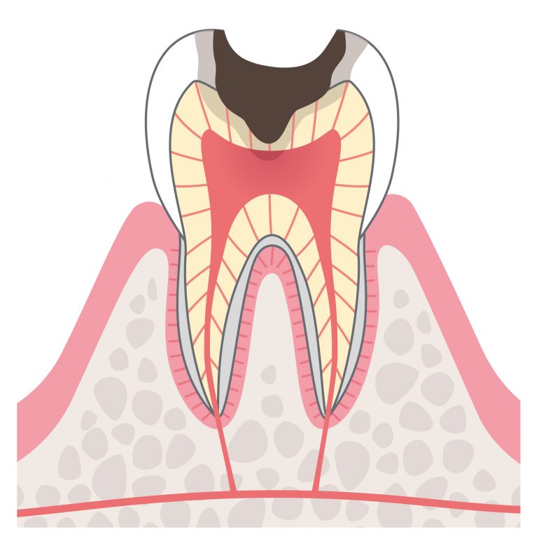 ステージ３　中等度むし歯（象牙質う蝕）