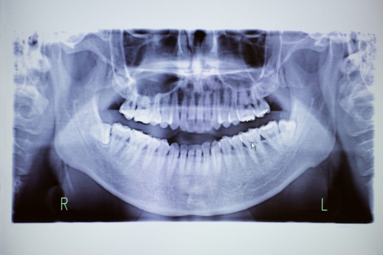 歯周外科について