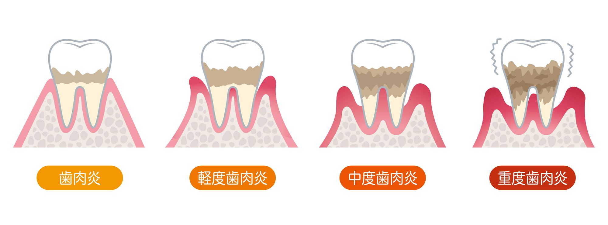 歯周病の進行度と症状